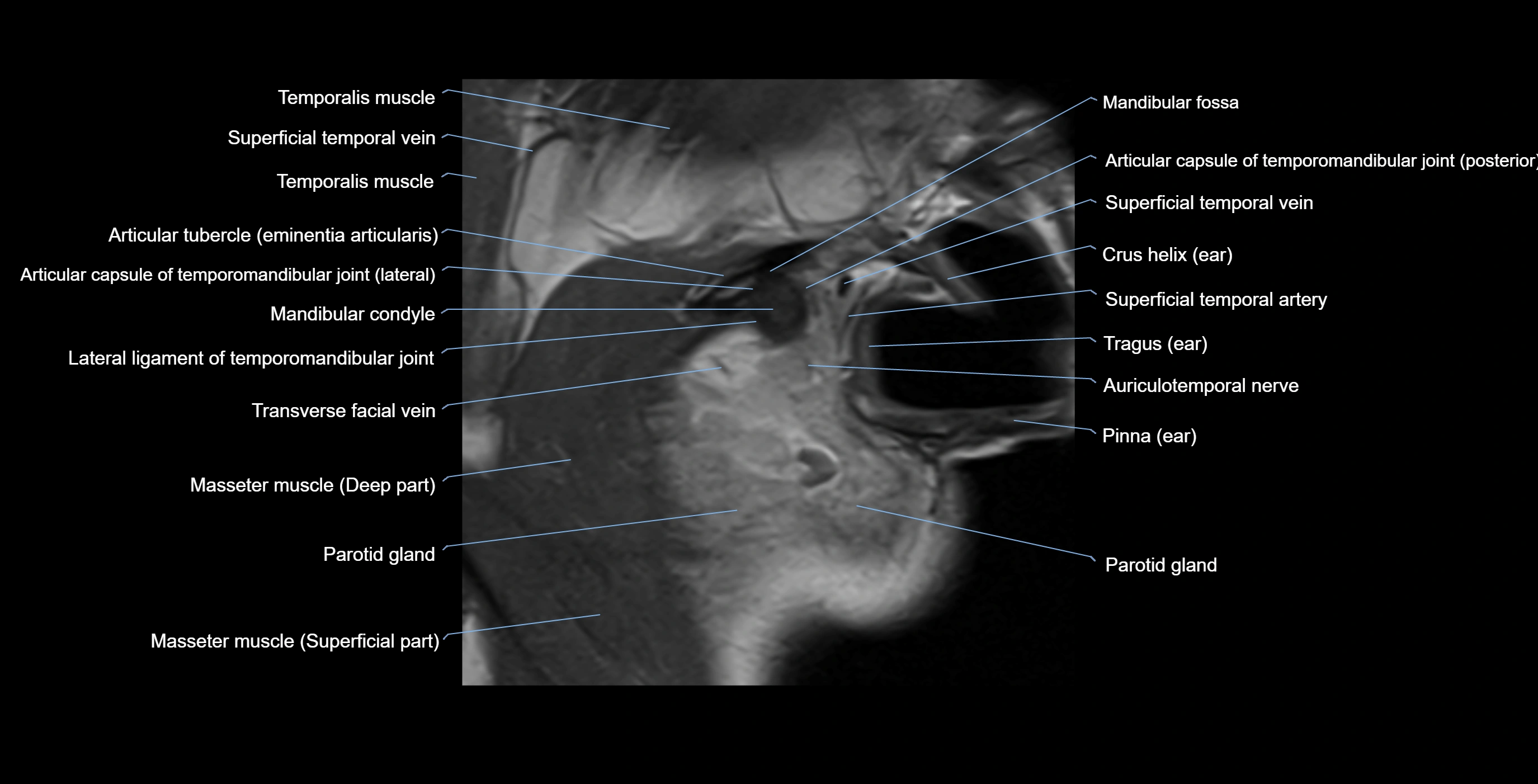 MRI TMJ sagittalclosed  mouth cross sectional 3T anatomy -img-00001-00003.webp